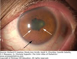 Image result for Ciliary Flush