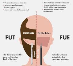 Shu uemura essence absolue overnight hair serum. Hair Transplant On Scar Can It Really Hide My Scar Elithair