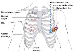 Ecg Lead Positioning Litfl Medical Blog Ecg Library Basics