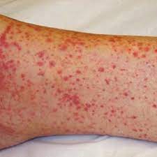Death Rashes Are More Than Skin Deep Mdedge Internal Medicine