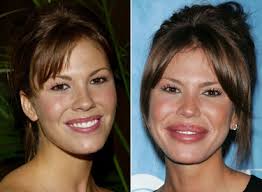 We explain how to get a loan for an upcoming procedure. Bad Plastic Surgery Gallery