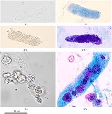 Image result for Urinary Cast