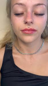 Beautiful soft natural lips 💖 first time client for lip filler and she  loved them ❤️ #lips #fillers #fillersinjection #fillerbeforeandafter  #LipFillerTransformation #NaturalResults