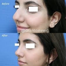 Another happy patient 😄🙏Rhinoplasty result one year after the surgery