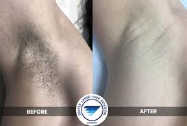 Say goodbye to unwanted hair forever. Laser Hair Removal London Simply Laser Hair Removal