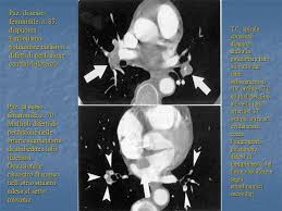 La diagnosi è molto affidabile. Embolia Polmonare Fisiopatologia Ppt Video Online Scaricare