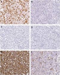 What's the name of the new drug for mesothelioma? Overexpression And Altered Glycosylation Of Muc1 In Malignant Mesothelioma British Journal Of Cancer