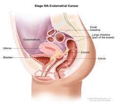 Womb cancer is the most commonly occurring cancer of the female reproductive system. Uterine Cancer General Information Symptoms Signs Of Endometrial Cancer Cleveland Oh University Hospitals