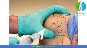 Image result for Subacromial Space Injection