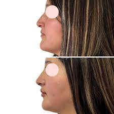 Rino lips 🩷 Es un procedimiento con ácido hialurónico (rinomodelación +  relleno de labios) que me encanta. Ayuda muchísimo a mejorar el perfil y a  armonizar el rostro en general. Muchas gracias