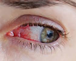 Do you frequently get red eyes? Home Remedies For Bloodshot Eyes American Academy Of Ophthalmology