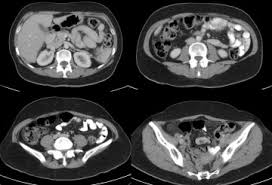 Serous papillary carcinoma of peritoneum. Well Differentiated Papillary Mesothelioma Clustering In A Portuguese Family With A Germline Bap1 Mutation Sciencedirect