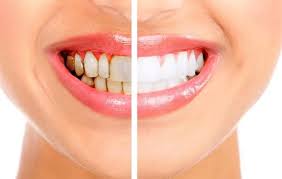 Which kits & methods can you trust? Teeth Whitening Options Professional And At Home Whitening In Our Santa Rosa Office Dentist In Santa Rosa