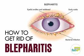 Do You Often Wake Up With Sticky And Crusty Deposits On Your Eyelids Do You Often Experience Regular Redn Blepharitis Dry Eye Remedies Eye Irritation Remedies