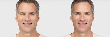 In your 20s, botox is used largely for preventative purposes. Your Guide To Botox For Men California Skin Institute