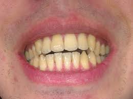 We did not find results for: The Tips Of My Teeth Are Turning Opaque Should I Be Worried Also My Teeth Have Been Yellow Ish For As Long As I Can Remember Is There Any Way To Whiten Them