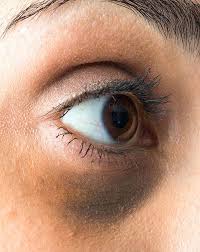 Image result for Proptosis