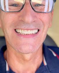 🔹️ Chega um momento em que temos que dar valor ao que importa. E nada mais  importante do que SORRIR MELHOR., 🔹️ Através do planejamento digital,  neste caso temos lentes cerâmicas, coroas cerâmicas sob ...