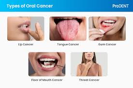 Image result for gums cancer symptoms
