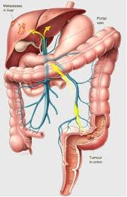 Read about the symptoms of bowel cancer. Sirtex Colorectal Cancer In The Liver