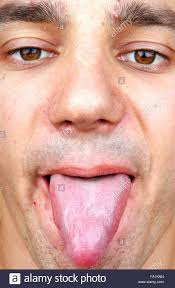 Bakterielle Infektion Krankheit Zunge Bei Einem Mann Stockfotografie Alamy