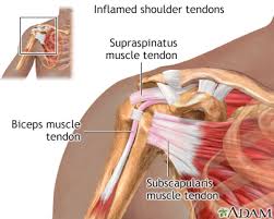 As it was mentioned above, the inflammation of the supraspinatus muscle tendon is often associated with the shoulder impingement syndrome. Rotator Cuff Problems Medlineplus Medical Encyclopedia
