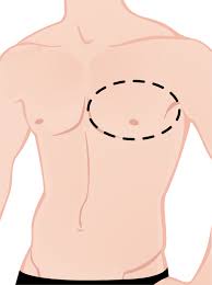Due to the low incidence, there are no randomized clinical studies giving information on the optimal diagnostics and therapy for male breast cancer patients. Male Breast Cancer Fort Lauderdale Fl Dr Burgers