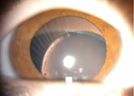 Image result for Homocystinuria