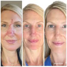 I used a new product recently, it's a silicone gel that cures in about 5  minutes, it's tricky but with practice could be helpful to some people.  Here's a quick scar I