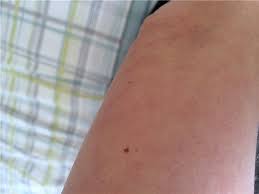 I know that purpura is elevated and that spider angiomas (easly recognizable) refill from the center to the periphery when pressure is applied. Is This Related To Lupas Hi Have Come Lupus Patients Un