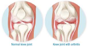 Maybe you would like to learn more about one of these? Moving Away From Knee Osteoarthritis Harvard Health