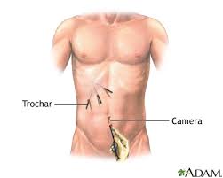 It has been a week since my gallbladder has been laparoscopically removed and i still experience pain above the upper central incision. Gallbladder Removal Laparoscopic Discharge Information Mount Sinai New York