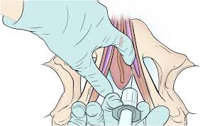 Image result for Pudendal Block