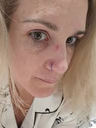 Hi everyone! I got my tragus pierced about 5 weeks ago and recently  developed a bump. I've been cleaning twice a day with a sterile saline  solution, never touch or play with