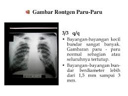 Gambar Rontgen Paru Paru Ppt Download