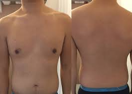 Maybe you would like to learn more about one of these? Nephrotic Syndrome And A Maculopapular Rash American Journal Of Kidney Diseases