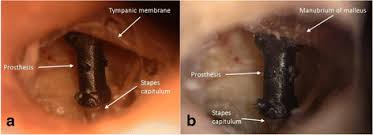 Image result for Ossicular Chain Disruption