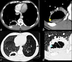 Image result for Lung Abscess