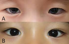 Lower eyelid epiblepharon