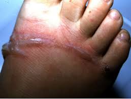 Check spelling or type a new query. Plant Dermatitis Dermnet Nz