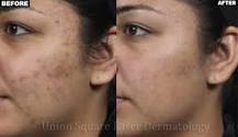 Image result for how expensive is isolaz treatment