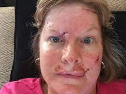 As the name suggests, this type the ncscp reports that men are twice as likely as women to develop basal cell cancers and have still, it's important to protect your skin from burning, so talk with your doctor about how to choose the. Woman Shares Shocking Selfies Showing Recovery From Skin Cancer Surgery In Warning Against Sunbeds And Not Using Suncream The Independent The Independent