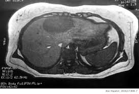 It is mainly found in the abdominal cavity, most commonly on the surface of the ovaries. Rare Case Of Hepatic Endometriosis As An Incidental Finding Difficult Diagnosis Of A Diagnostic Dilemma Annals Of Hepatology