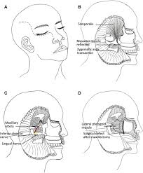 (moure's incision) if incision is extended along superior orbital rim, divide trochlea retract and protect orbit with malleable retractors work towards vessels, divide and ligate/cauterise divide nasolacrimal duct tangentially raise skin on face of maxilla to infraorbital nerve operative otolaryngology. Maxillary Fronto Temporal Approach For Removal Of Recurrent Malignant Infratemporal Fossa Tumors Anatomical And Clinical Study Sciencedirect