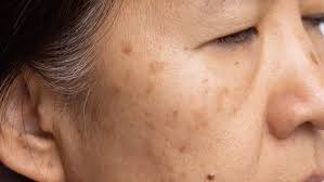 Age Spots/Brown Spots