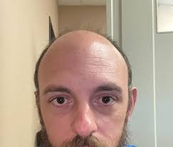 2 Transplant, 8 ay arayla. Şu anda 2. transplant sonrası 10. gündeyim :  r/HairTransplants