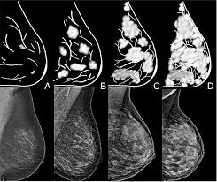 Image result for Mammogram Interpretation