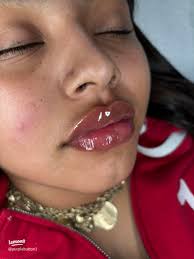 Stunning Lip Filler Inspiration for Flawless Pouts