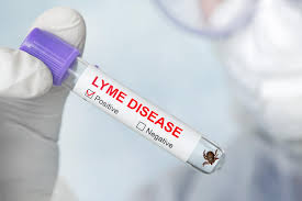 Borelioza (choroba z lyme) jest wieloukładową chorobą spowodowaną zakażeniem krętkiem borrelia burgdorferi przenoszonym przez. Borelioza Objawy Przyczyny Leczenie Jakie Sa Objawy Boreliozy I Jak Leczyc Borelioze Poradnikzdrowie Pl