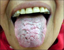 Image result for Fissured tongue